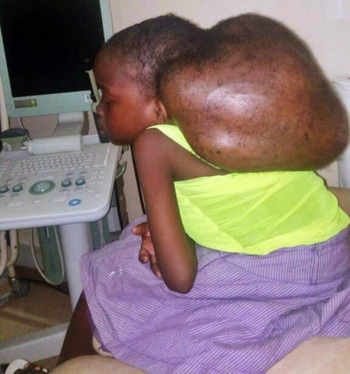 Precious Moses With Head Tumor
