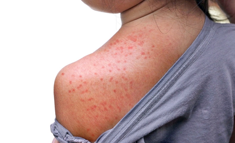 Child with Signs of Measles