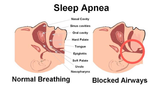 Sleep Apnea